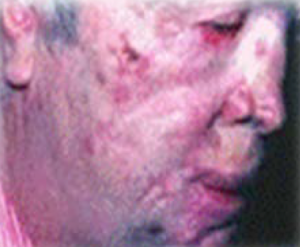 Patient with basal cell carcinoma