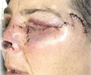 Patient with basal cell carcinoma