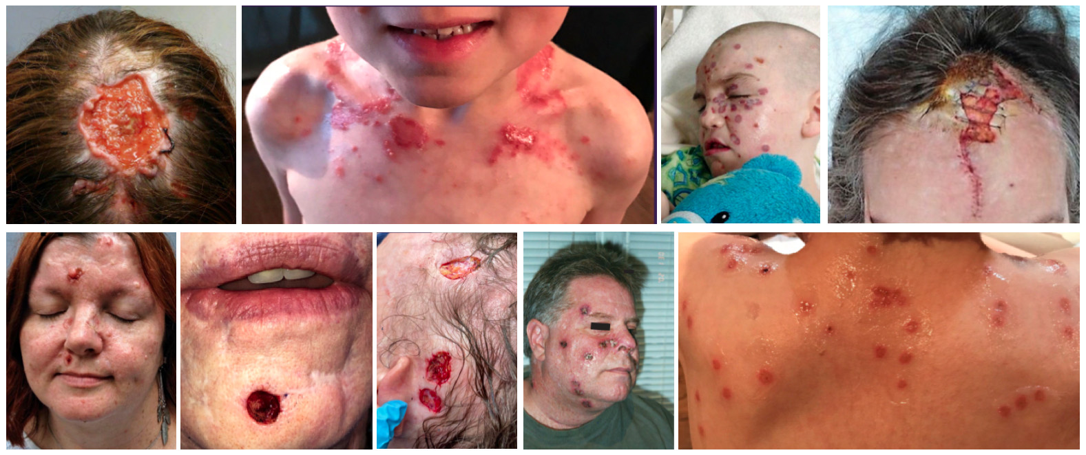 Images - Patients suffering from BCCNS